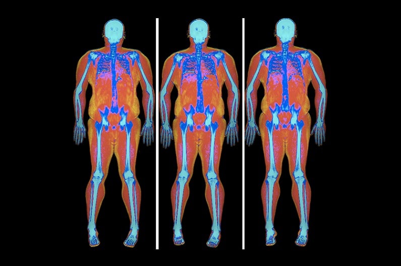 Dexa Scan Facts You Must Know